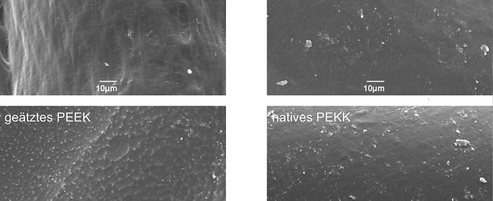 Unterkieferrekonstruktion mit spezifischen PEEK-Implantaten